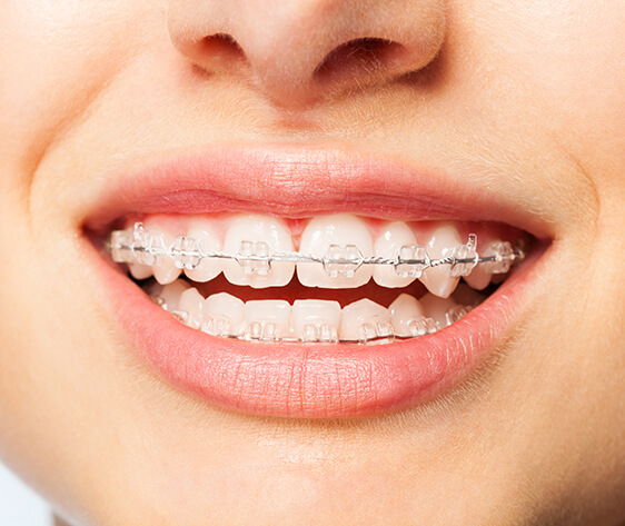 Healthy smile woman with clear brackets