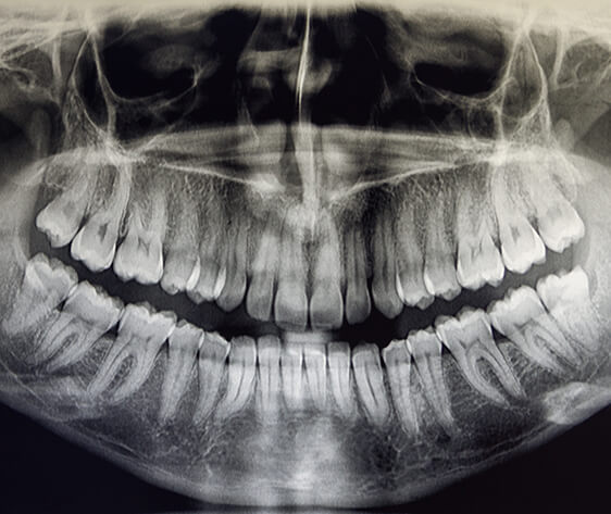 Orthopantomography of an adult patient, dentistry